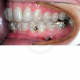Bond Aligner