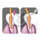 Gutta Cutter